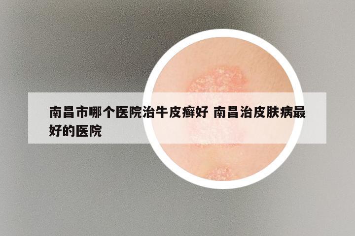 南昌市哪个医院治牛皮癣好 南昌治皮肤病最好的医院