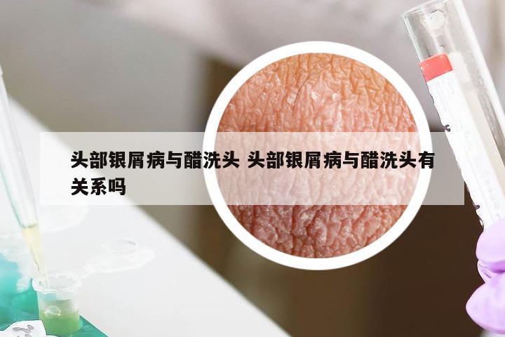 头部银屑病与醋洗头 头部银屑病与醋洗头有关系吗