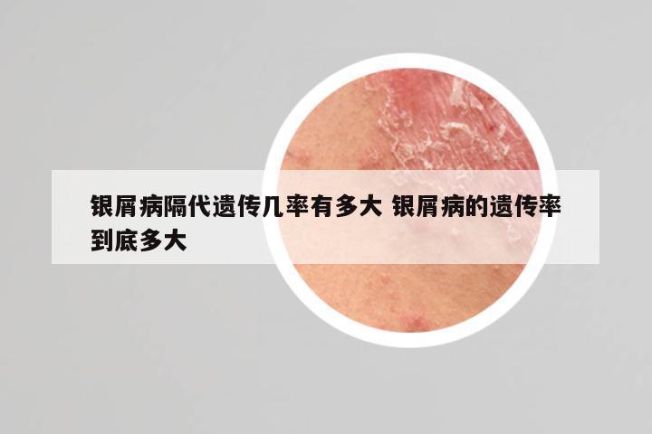 银屑病隔代遗传几率有多大 银屑病的遗传率到底多大