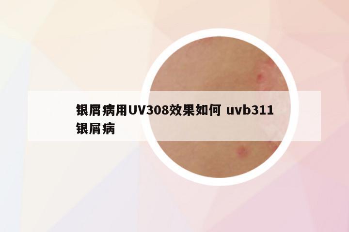 银屑病用UV308效果如何 uvb311银屑病