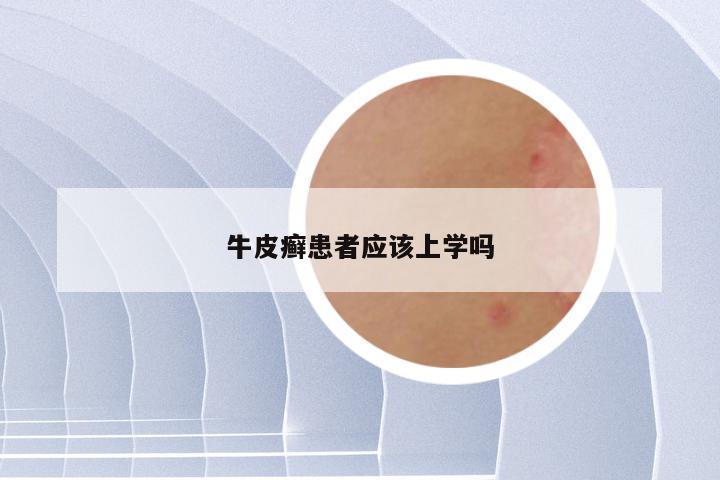 牛皮癣患者应该上学吗