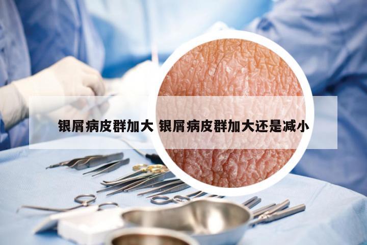 银屑病皮群加大 银屑病皮群加大还是减小