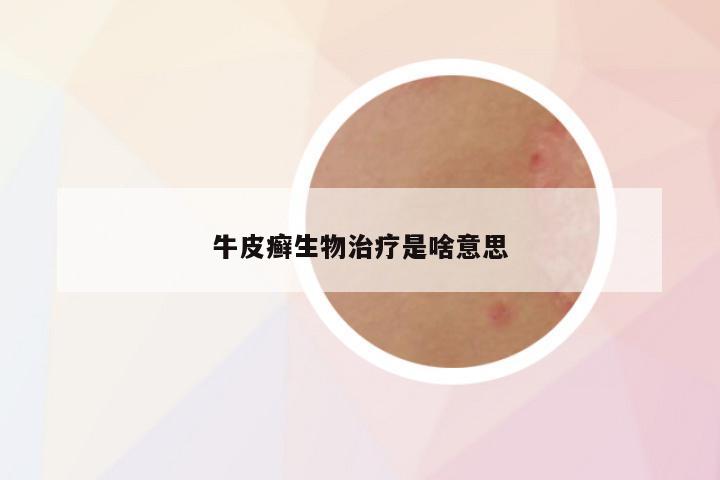 牛皮癣生物治疗是啥意思