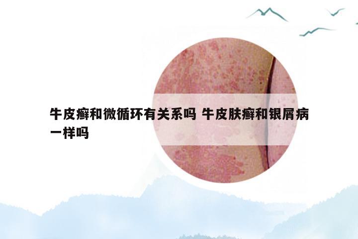 牛皮癣和微循环有关系吗 牛皮肤癣和银屑病一样吗