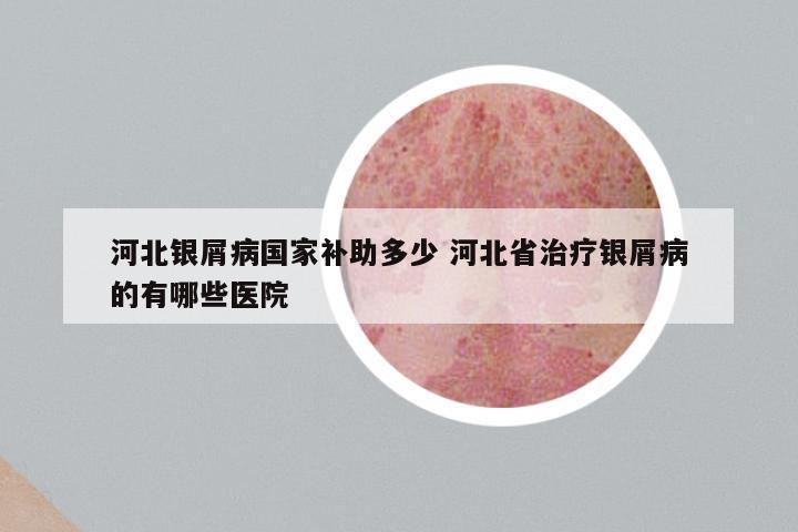 河北银屑病国家补助多少 河北省治疗银屑病的有哪些医院