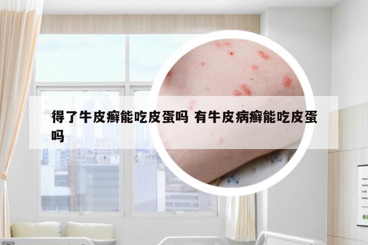 得了牛皮癣能吃皮蛋吗 有牛皮病癣能吃皮蛋吗