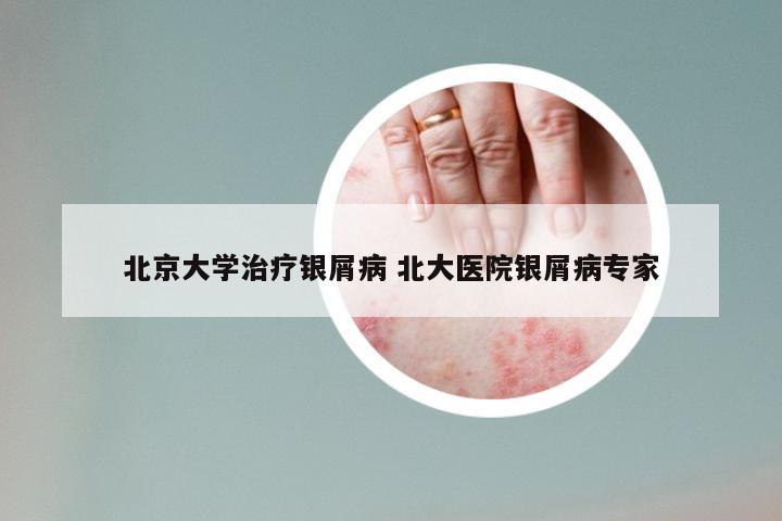北京大学治疗银屑病 北大医院银屑病专家