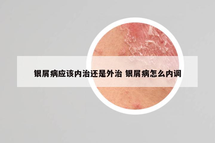 银屑病应该内治还是外治 银屑病怎么内调