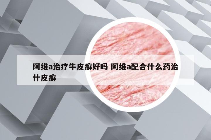 阿维a治疗牛皮癣好吗 阿维a配合什么药治什皮癣