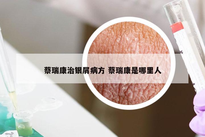 蔡瑞康治银屑病方 蔡瑞康是哪里人