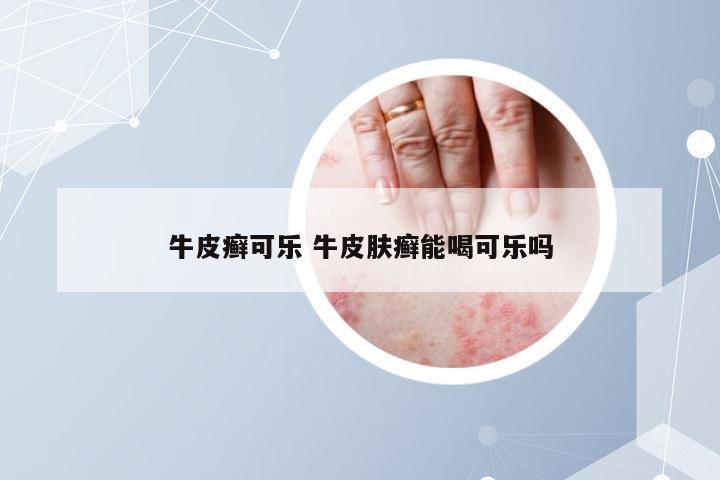 牛皮癣可乐 牛皮肤癣能喝可乐吗