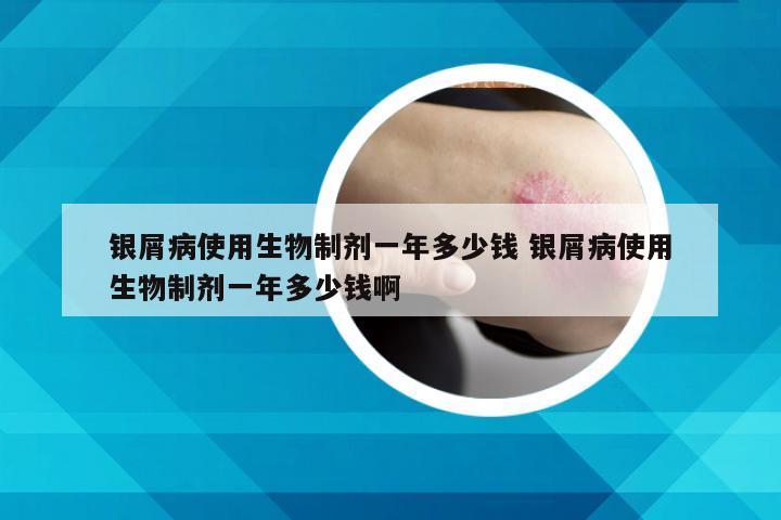 银屑病使用生物制剂一年多少钱 银屑病使用生物制剂一年多少钱啊