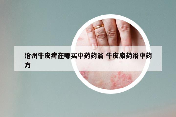 沧州牛皮癣在哪买中药药浴 牛皮廨药浴中药方