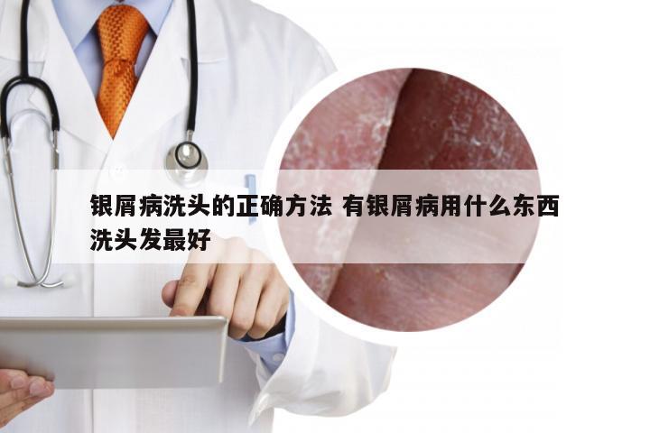 银屑病洗头的正确方法 有银屑病用什么东西洗头发最好