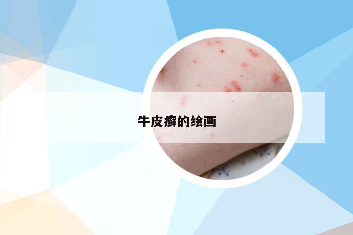 牛皮癣的绘画