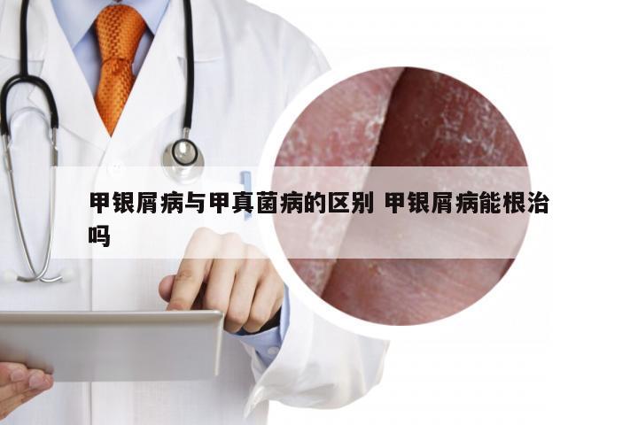 甲银屑病与甲真菌病的区别 甲银屑病能根治吗