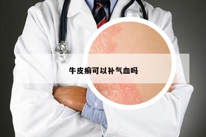牛皮癣可以补气血吗