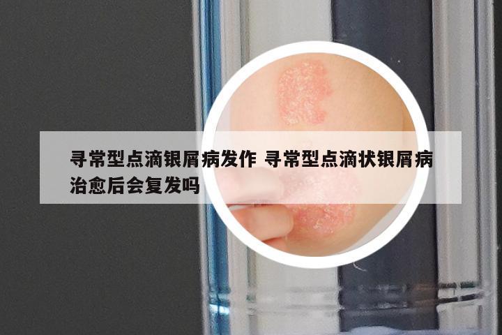 寻常型点滴银屑病发作 寻常型点滴状银屑病治愈后会复发吗