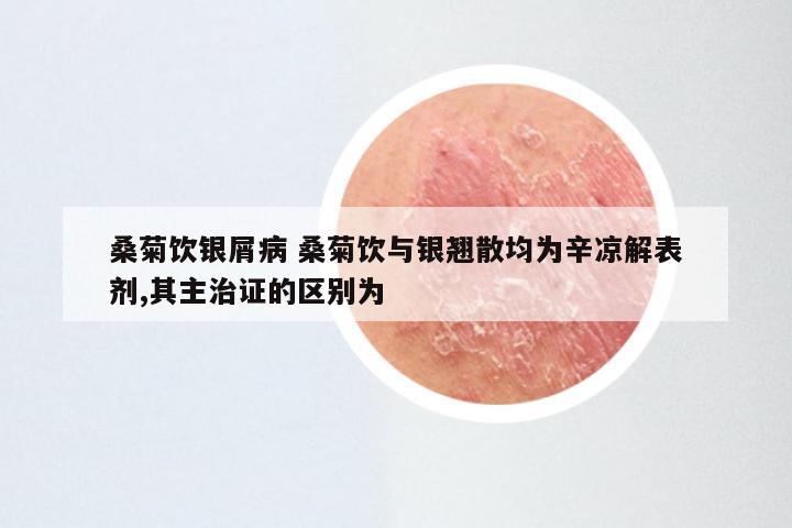 桑菊饮银屑病 桑菊饮与银翘散均为辛凉解表剂,其主治证的区别为