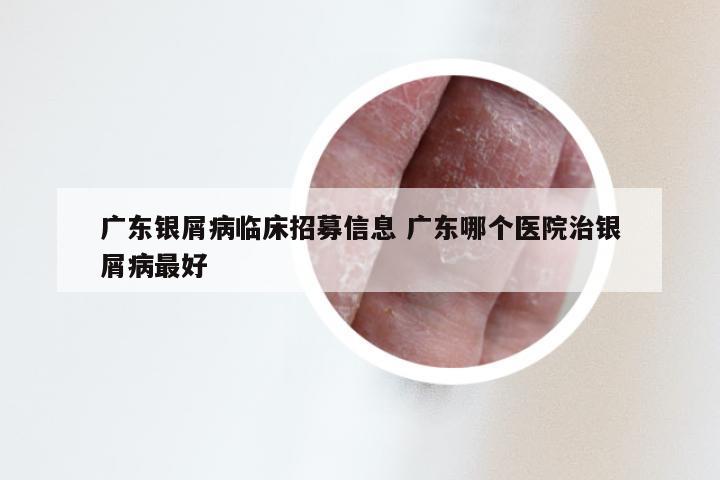 广东银屑病临床招募信息 广东哪个医院治银屑病最好