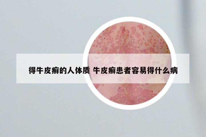 得牛皮癣的人体质 牛皮癣患者容易得什么病