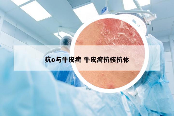 抗o与牛皮癣 牛皮癣抗核抗体