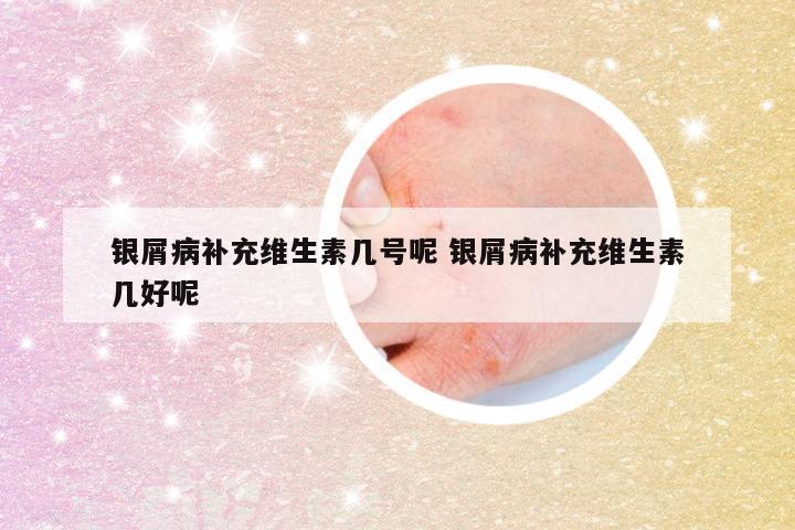 银屑病补充维生素几号呢 银屑病补充维生素几好呢