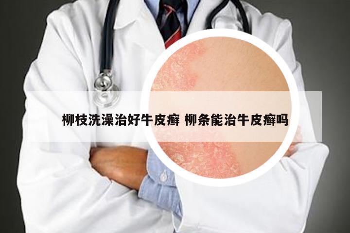 柳枝洗澡治好牛皮癣 柳条能治牛皮癣吗