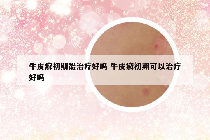牛皮癣初期能治疗好吗 牛皮癣初期可以治疗好吗