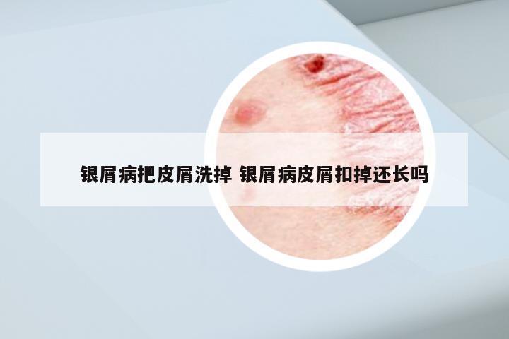 银屑病把皮屑洗掉 银屑病皮屑扣掉还长吗