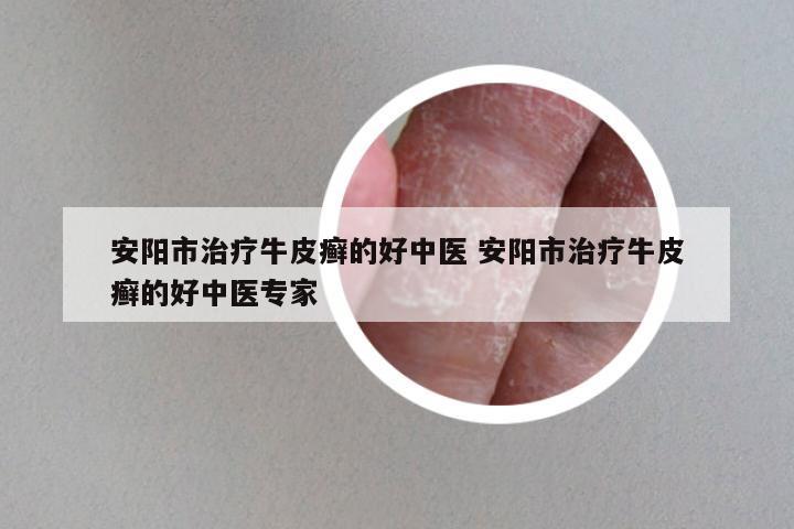 安阳市治疗牛皮癣的好中医 安阳市治疗牛皮癣的好中医专家