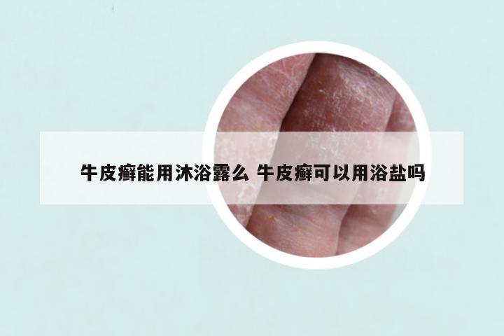 牛皮癣能用沐浴露么 牛皮癣可以用浴盐吗