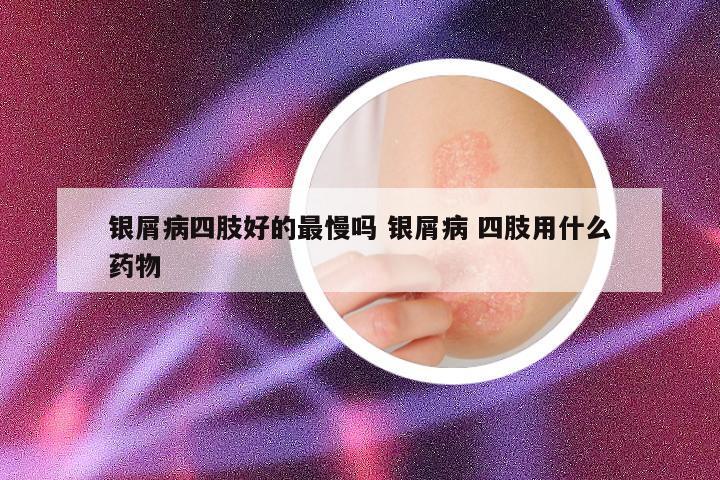 银屑病四肢好的最慢吗 银屑病 四肢用什么药物