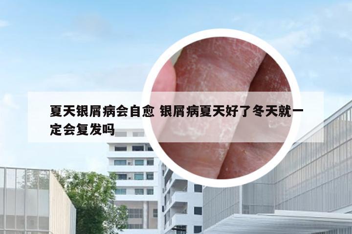 夏天银屑病会自愈 银屑病夏天好了冬天就一定会复发吗