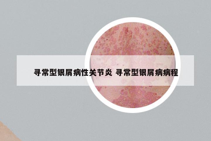 寻常型银屑病性关节炎 寻常型银屑病病程