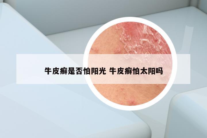牛皮癣是否怕阳光 牛皮癣怕太阳吗