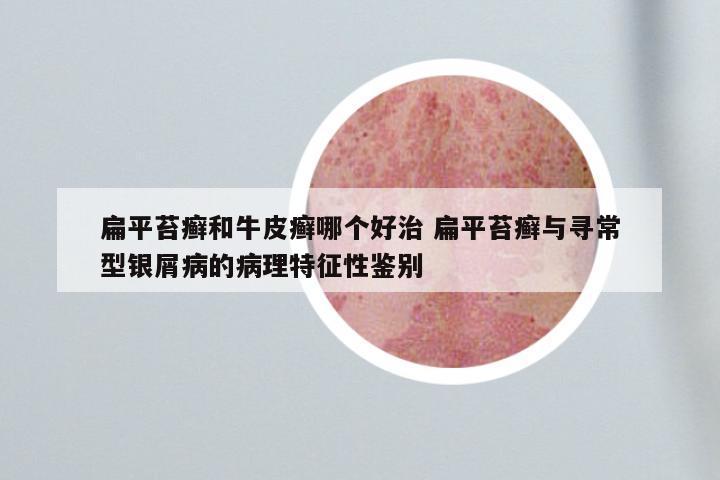 扁平苔癣和牛皮癣哪个好治 扁平苔癣与寻常型银屑病的病理特征性鉴别