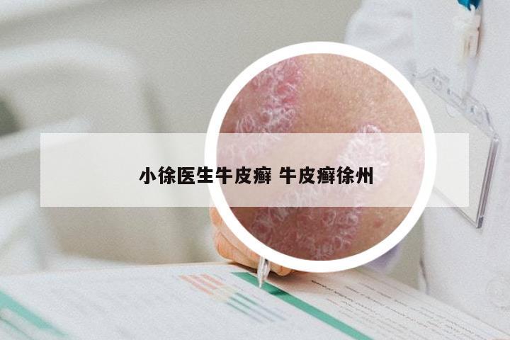 小徐医生牛皮癣 牛皮癣徐州