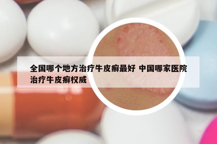 全国哪个地方治疗牛皮癣最好 中国哪家医院治疗牛皮癣权威