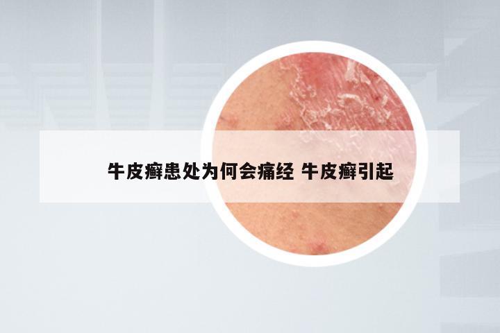 牛皮癣患处为何会痛经 牛皮癣引起