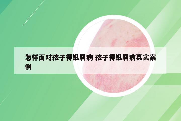 怎样面对孩子得银屑病 孩子得银屑病真实案例