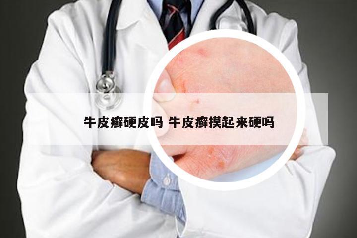牛皮癣硬皮吗 牛皮癣摸起来硬吗