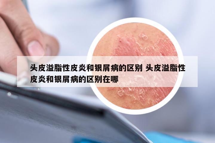 头皮溢脂性皮炎和银屑病的区别 头皮溢脂性皮炎和银屑病的区别在哪