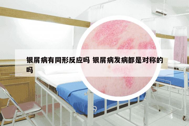 银屑病有同形反应吗 银屑病发病都是对称的吗