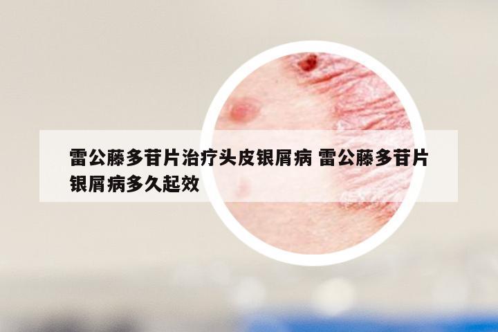 雷公藤多苷片治疗头皮银屑病 雷公藤多苷片银屑病多久起效