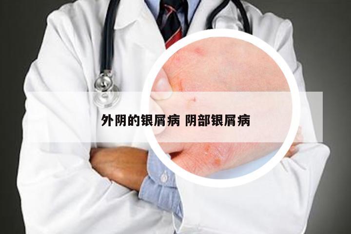 外阴的银屑病 阴部银屑病