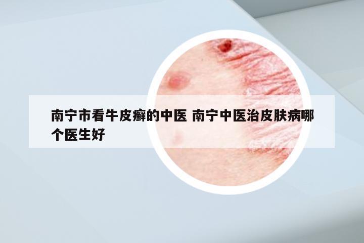 南宁市看牛皮癣的中医 南宁中医治皮肤病哪个医生好