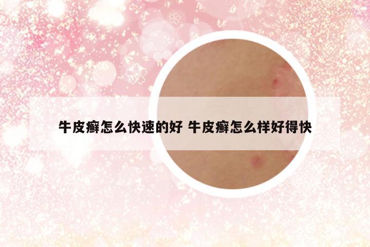 牛皮癣怎么快速的好 牛皮癣怎么样好得快