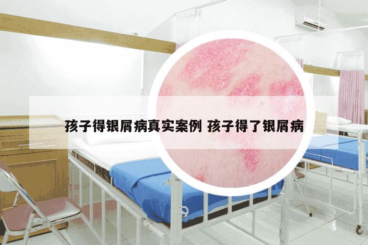 孩子得银屑病真实案例 孩子得了银屑病