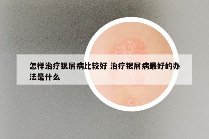 怎样治疗银屑病比较好 治疗银屑病最好的办法是什么